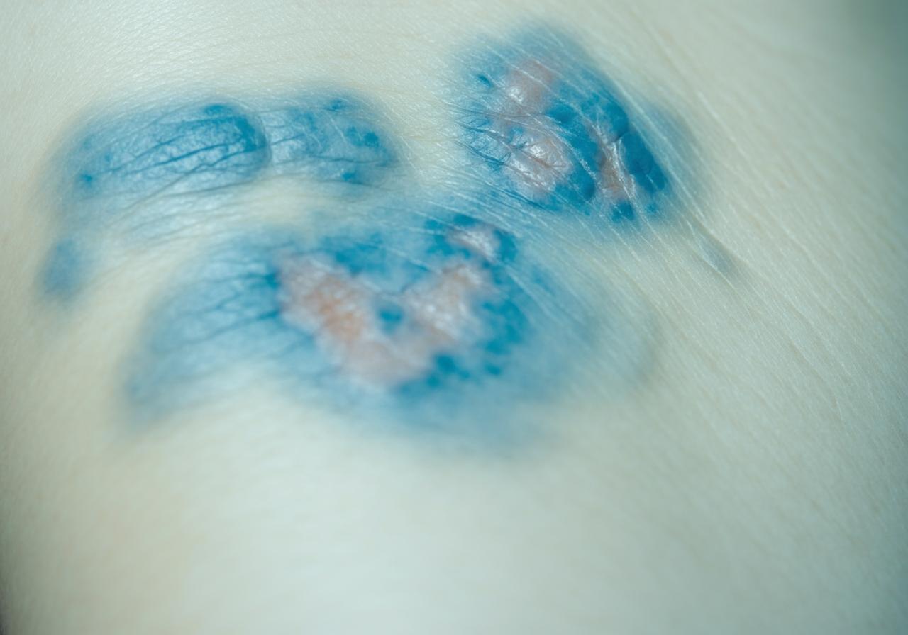 What You Should Know About Blue Waffle Disease